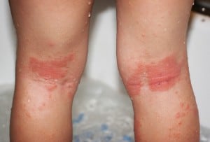 Atopic Dermatitis