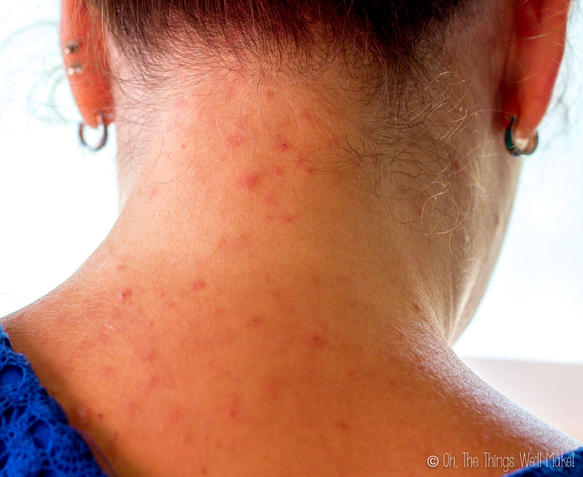 The back of a girl's neck showing a rash from lice