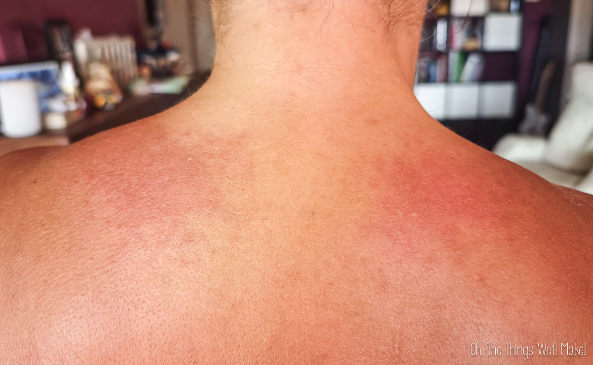A close-up of a person's upper back and shoulders showing mild redness and irritation.